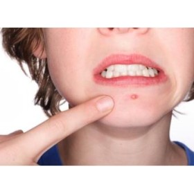 Benzac 5% Gel Trattamento antiacne 40 g