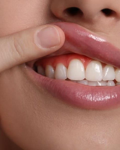 Gengive che sanguinano: cause e rimedi efficaci Gengive che sanguinano: cause e rimedi efficaci