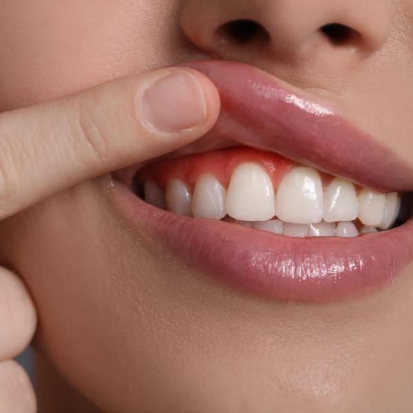 Gengive che sanguinano: cause e rimedi efficaci